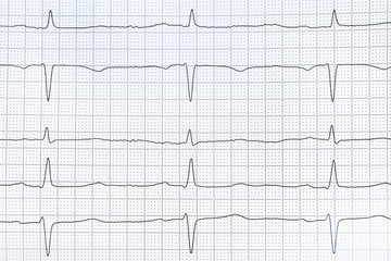 Cardiogram report as background, top view. Heart diagnosis