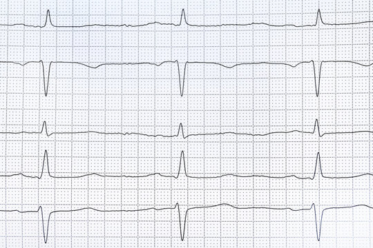 Cardiogram report as background, top view. Heart diagnosis