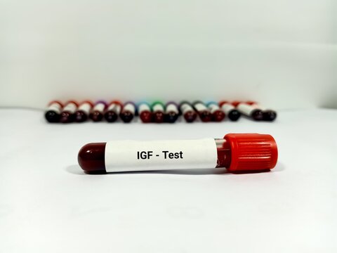 Test Tube with blood sample for IGF-1 (insulin-like growth factor-1) or somatomedin C test. A medical testing concept in the laboratory background.