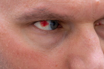Fototapeta na wymiar A close up of a subconjunctival hemorrhage red blood spot in a caucasian man's eye near iris for medical and educational concepts.