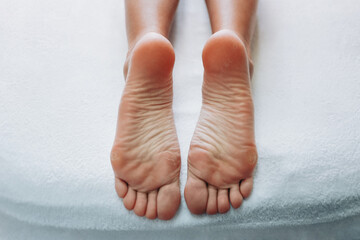 Closeup of woman feet with calluses and dry skin on towel in a procedure cabinet. Foot and toes care concept.