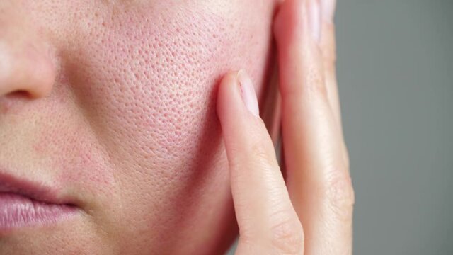 Skin texture with enlarged pores. Part of a woman's face close-up. Irritation, allergies, problem skin.