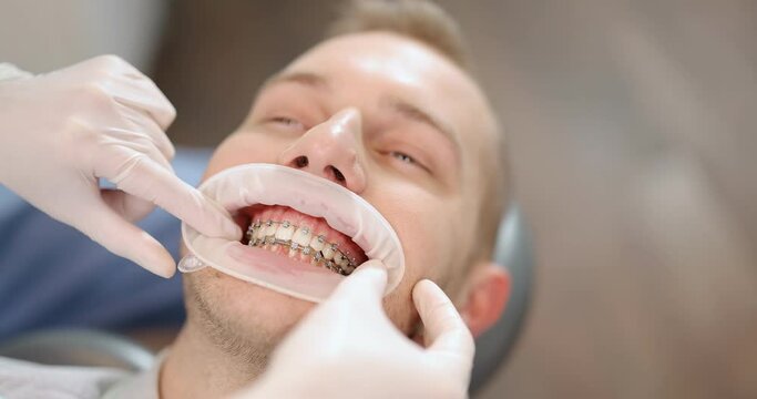 Patient with dental braces during an orthodontic treatment. Close-up on a patient's mouth opened with dental optragate