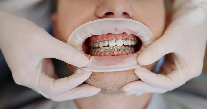 Patient with dental braces during an orthodontic treatment. Dentist checking dental bite. Close-up on a patient's mouth opened with dental optragate