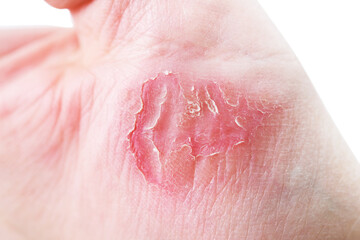Fototapeta premium Atopic dermatitis (AD), also known as atopic eczema, is a type of inflammation of the skin (dermatitis) 