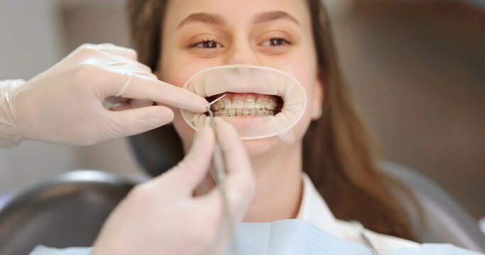 Girl with dental braces during an orthodontic treatment. Close-up on a patient's mouth opened with dental optragate