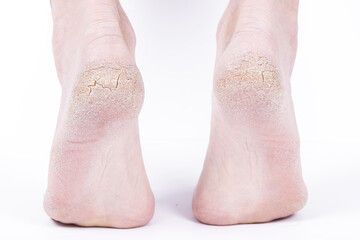 Cracked heels legs of a person