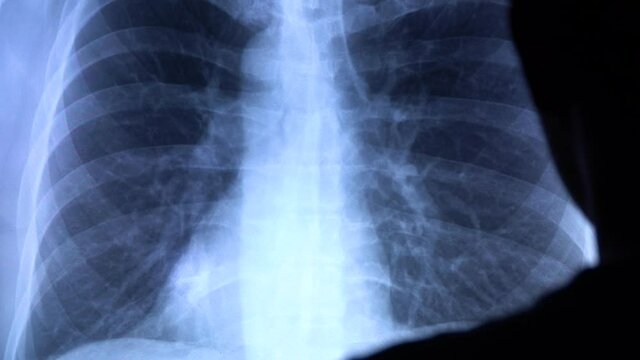 A doctor with a pen checks a medical x-ray of lungs with pneumonia on a big sensor screen. Doctor zooms and points on a radiology chest scan showing lungs affected by pneumonia. 4k close-up video.