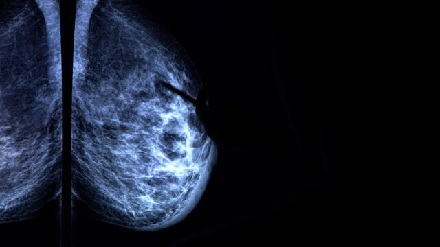 Doctor with a pen zooms and checks a mammogram x-ray on a big sensor screen. Medical mammography diagnostic to prevent breast cancer. 4k close up video.