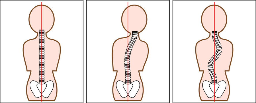 脊柱側弯症 の画像 12 524 件の Stock 写真 ベクターおよびビデオ Adobe Stock