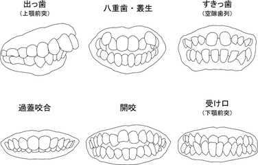 歯列矯正治療の対象になる代表的な症例線画セット（塗りなし）