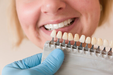 close up of using a shade guide to check veneer of teeth for bleaching