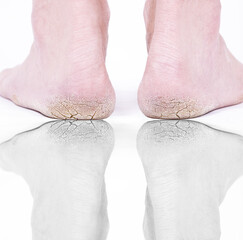 Cracked heels legs of a person. reflection