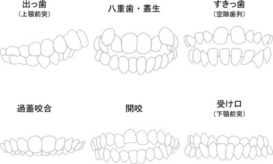 歯列矯正治療の対象になる代表的な症例セット（歯のみ）　ベタ塗り線あり