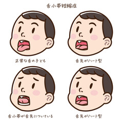 舌小帯短縮症の子どものイラスト