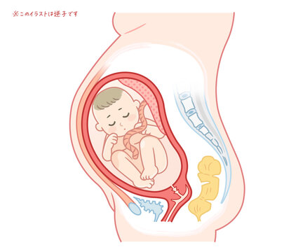 逆子の赤ちゃんのイラスト