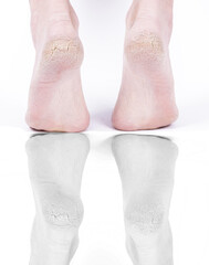 Cracked heels legs of a person. reflection