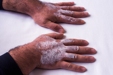 Young man hands using moisturizing white cream
