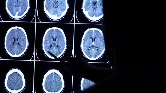 Medical scientist with a pen points at CT, MRI brain scan images on a big screen. Doctor neurologist checks tomography of a human brain. Radiology diagnostic of neurology diseases. 4k close-up video.