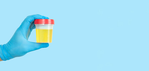 Hand holding urine sample container for medical urinalysis - obrazy, fototapety, plakaty
