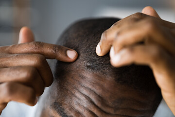 Young African Men Hair Loss