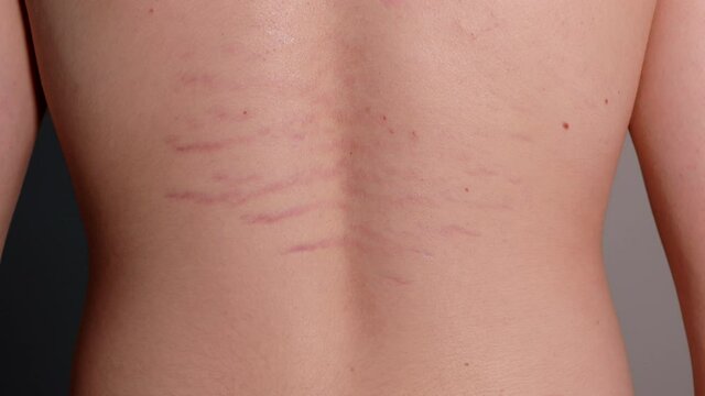 Close up view of young pearson's back with striae distensae (striae rubrae) background. The concept of impaired skin elasticity during puberty
