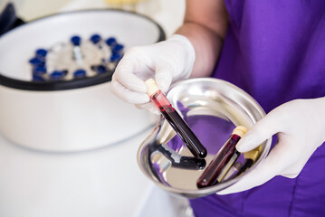 Platelet-Rich plasma preparation. Tube with blood in hands