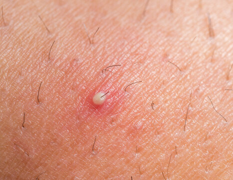 ingrown hair