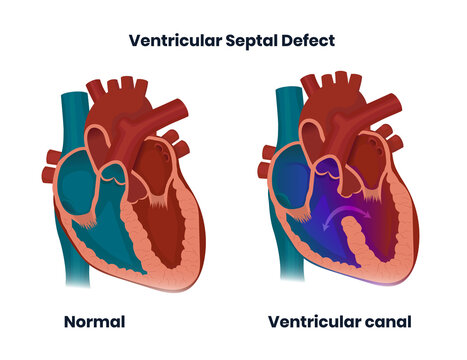 Ventricular septal defect with normal heart anatomy. Illustration of  the congenital heart defect