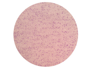 Leukemoid reaction describes an increased white blood cell count, or leukocytosis, which is a...