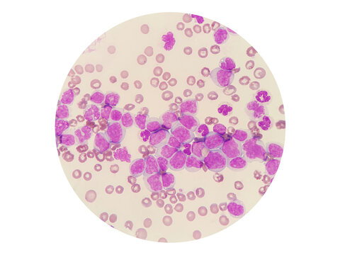 Acute myeloid leukemia (AML) is a type of blood cancer. Microscopic examination of blasts or leukemia cells  in blood smear of dog.