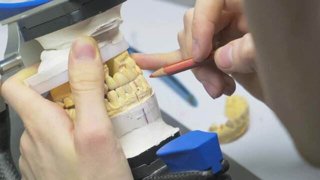The dentist makes marks on the bite, denture, artificial jaw, denture, hands working on the denture, artificial jaw. Slow motion, close-up.