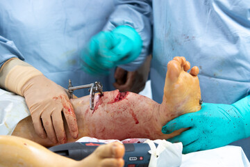 Leg surgery with Ilizarov apparatus installation close-up