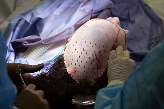 Head Skin Grafting Surgery Close-up With Surgeons Finishing The Sewing Of The Skin Flap With Drainage Openings