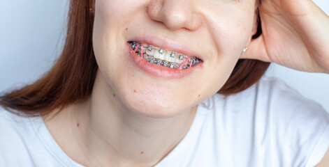 Braces in the smiling mouth of a girl. Smooth teeth from braces.