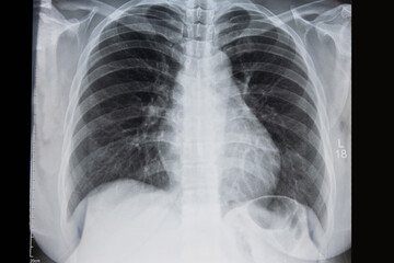 Background of Chest x-ray