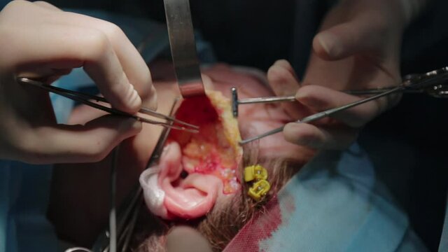 Plastic surgeon performs facelift surgery with a scalpel, tweezers and clamps, close up. High quality FullHD footage