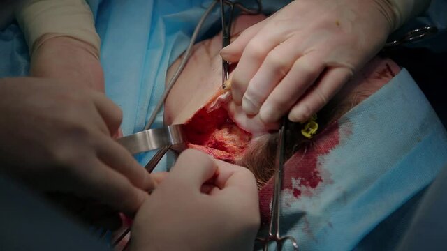 Plastic surgeon performs facelift surgery with a scalpel, tweezers and clamps, close up. High quality FullHD footage