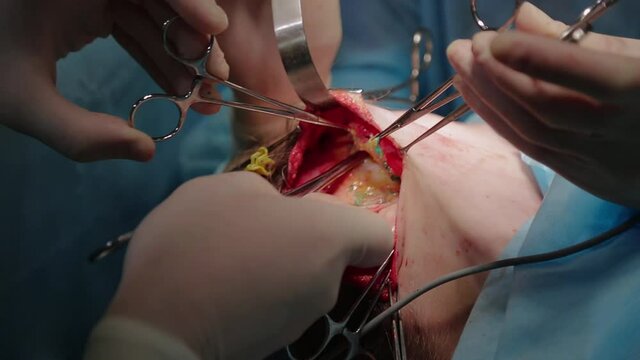 Plastic surgeon performs facelift surgery with a scalpel, tweezers and clamps, close up. High quality FullHD footage