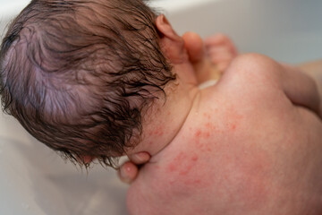 乳児湿疹がでている新生児の背中