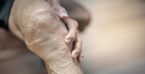 Close up of old man hand holding on the knee with suffering from knee pain. The sick legs of an old man with severely deformed knees affected by arthritis.