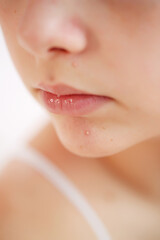 Fototapeta premium Teenage acne on the chin. Close up face with pimple. Teen problem. High quality photo.
