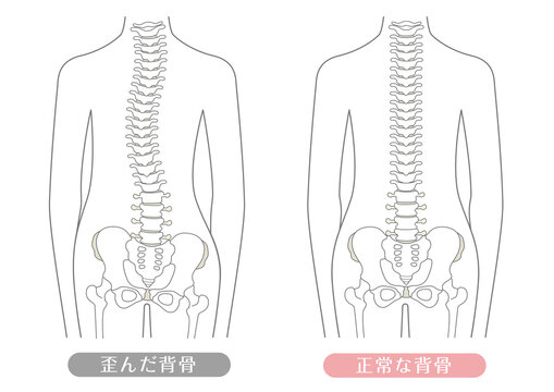 人間の体 正常な背骨と歪んだ背骨