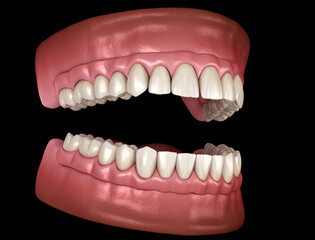 Maxillary and Mandibular prosthesis with gum All on 4 system supported by implants. Medically accurate 3D illustration of human teeth and dentures