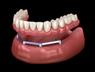 Mandibular prosthesis with gum All on 4 system supported by implants.  Medically accurate 3D illustration of human teeth and dentures concept