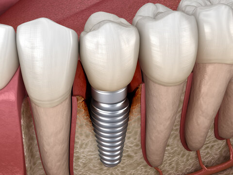 Periimplantitis with visible bone damage. Medically accurate 3D illustration of dental implants concept