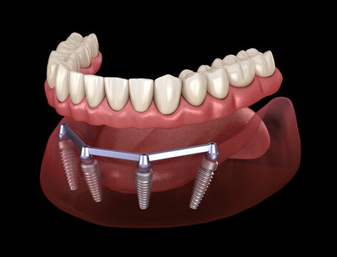 Mandibular prosthesis with gum All on 4 system supported by implants.  Medically accurate 3D illustration of human teeth and dentures concept
