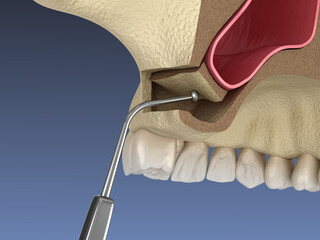 Sinus Lift Surgery - Moving sinus membrane. 3D illustration