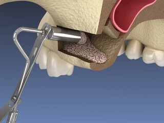 Sinus Lift Surgery - Adding new bone. 3D illustration © Alex Mit