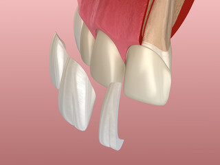 Veneer installation procedure over central incisor and lateral incisor. Sliced view, 3D illustration